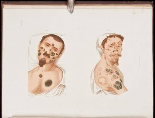 Atlas of Venereal Diseases