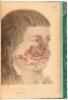 Delineations of Cutaneous Diseases: Exhibiting the characteristic appearances of the principal genera and species comprised in the classification of the late Dr. Willan; and completing the series of engravings begun by that author - 3