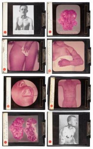 Approximately 30 glass lantern slides of individuals with rather horrific skin diseases and other deformities, plus tissue biopsies, etc.