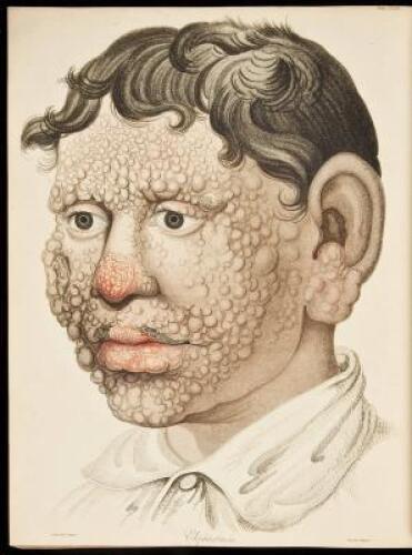 Delineations of Cutaneous Diseases: Exhibiting the Characteristic Appearances of the Principal Genera and Species Comprised in the Classification of the Late Dr. Willan and Completing the Series of Engravings Begun by that Author