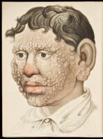 Delineations of Cutaneous Diseases: Exhibiting the Characteristic Appearances of the Principal Genera and Species Comprised in the Classification of the Late Dr. Willan and Completing the Series of Engravings Begun by that Author