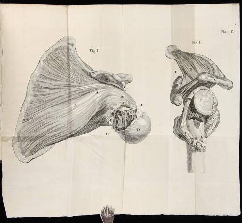 A Case of an Extra-Uterine Foetus. [In: Medical Observations and Inquiries, Vol. II]